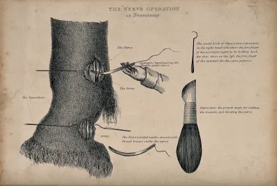 Nerve operation on an animal (a horse?): four figures, including illustrations of instruments used in the operation
