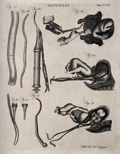 Nine diagrams illustrating breech and natural births and the obstetrical instruments used to assist them