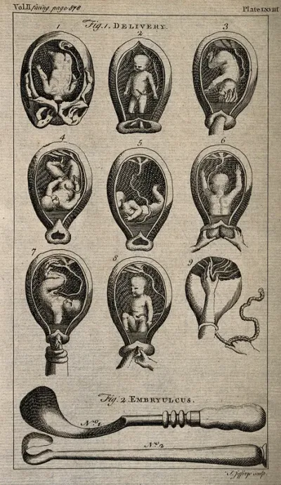 Nine diagrams of babies in the womb and two illustrations of obstetrical instruments