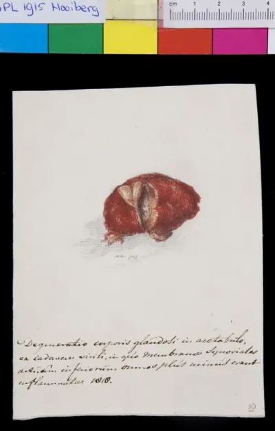 Pathology, acetabulum