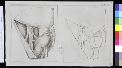 Pathology, fractures