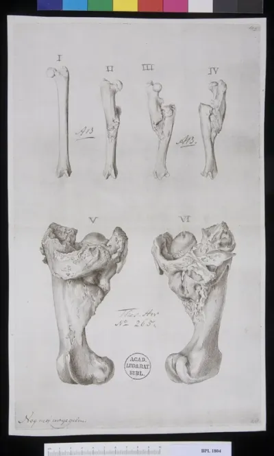 Pathology, fractures (Femur)