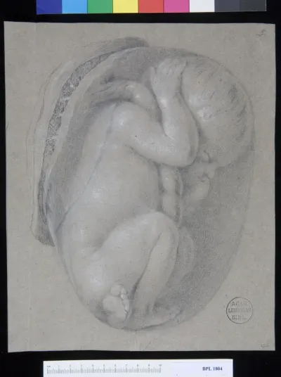 Pathology, fractures (Foetus)