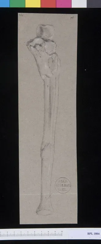 Pathology, fractures (Forearm)