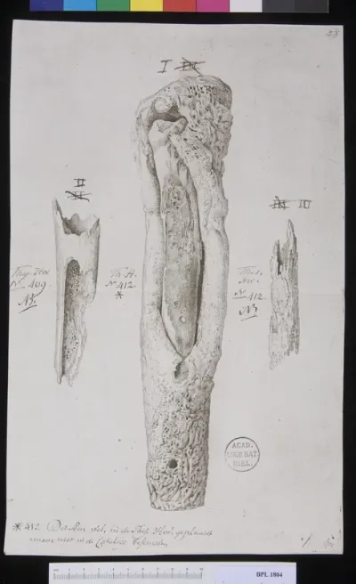 Pathology, fractures (Lower leg)