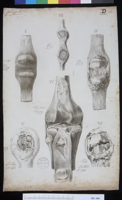 Pathology, fractures (Patella)