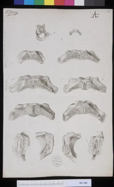 Pathology, fractures (Pelvis, female pubis)