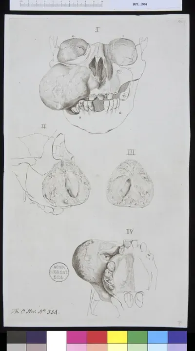 Pathology, fractures (Skull of the woman with a tumor in her cheek)