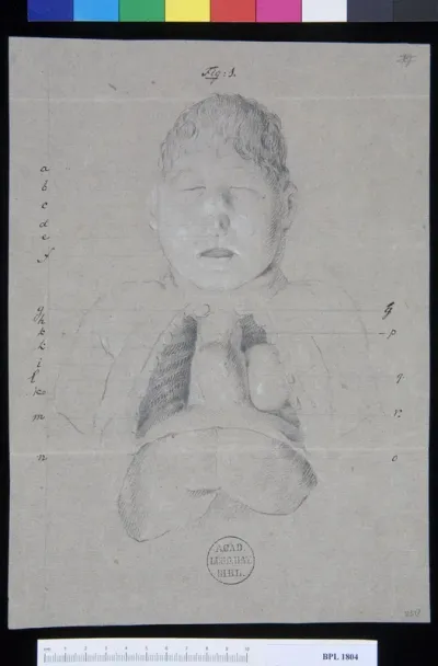 Pathology, fractures (Thorax of a child)