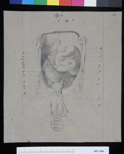 Pathology, fractures (Torso, organs)