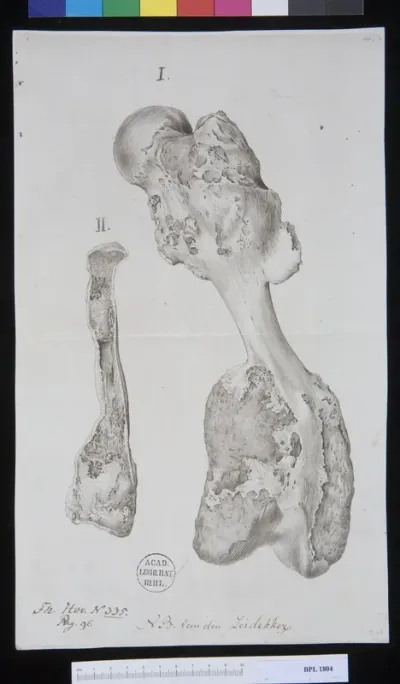 Pathology, fractures (vertebrae lumborum)