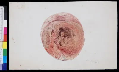 Pathology, heart