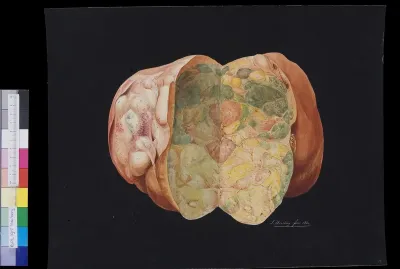 Pathology, liver