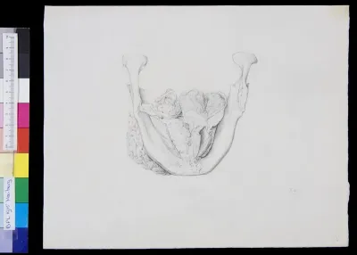 Pathology, skull, lower jaw