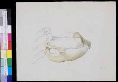 Pathology, spine with ribs