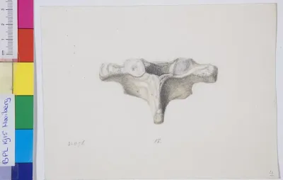 Pathology, vertebra