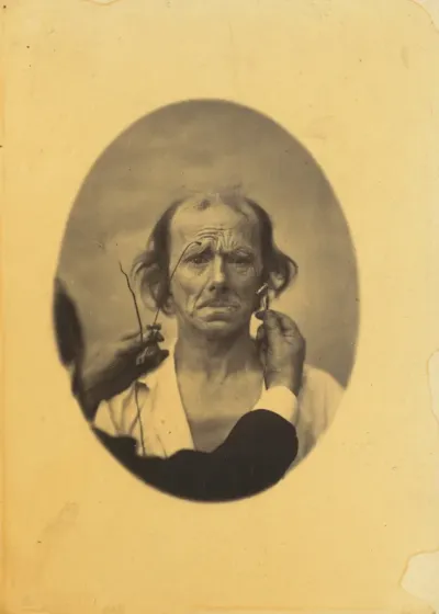 Plate 14: Designed to show a comparison between the maximal contraction of the superior part of m. orbicularis oculi and m. corrugator supercilii, in the same individual. On the left, very strong electrization of the superior part of m. orbicularis o