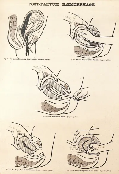 Post-partum haemorrhage