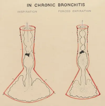 Schematic representation of chronic bronchitis
