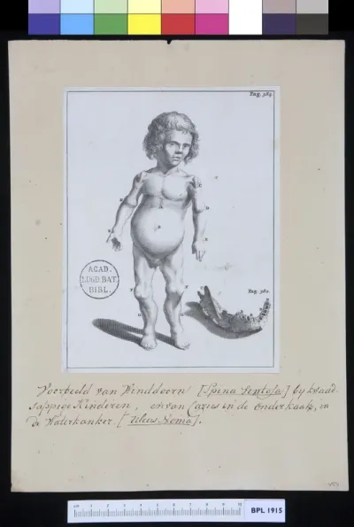 Scrofulous child with spina ventosa (verso: Unidentified subject)