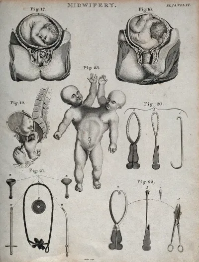 Seven diagrams illustrating difficult births, obstetrical instruments and a conjoined twin