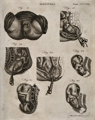 Seven diagrams illustrating the birth of a child with the use of forceps