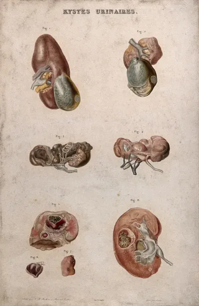 Several examples of a disease of the kidney (urinary cysts), numbered for key