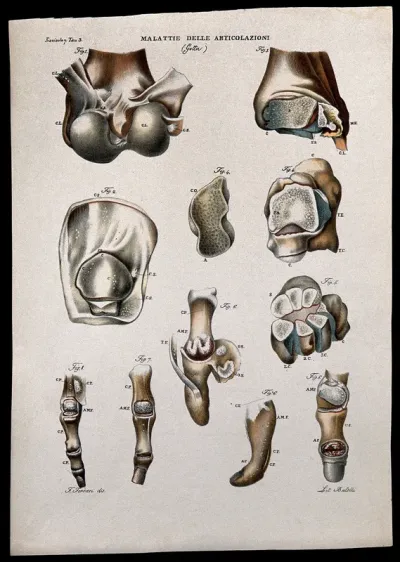Several examples of diseased joints (gout), numbered for key