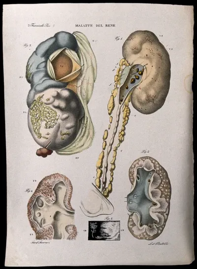 Several examples of diseased kidneys, numbered for key