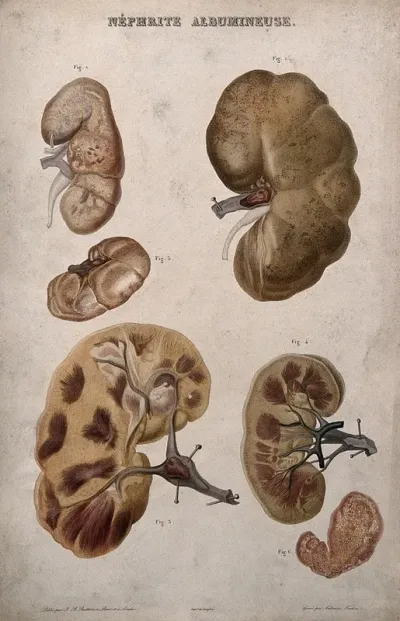 Several examples of diseased kidneys, numbered for key