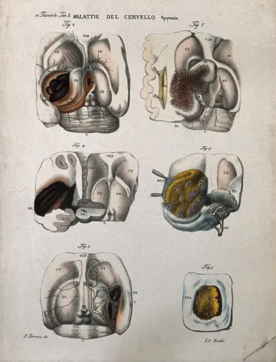 Several sections of diseased brain, numbered for key