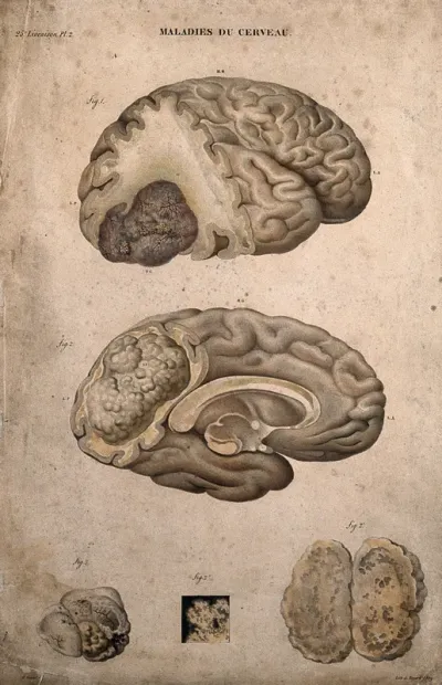 Several sections of diseased brain, numbered for key