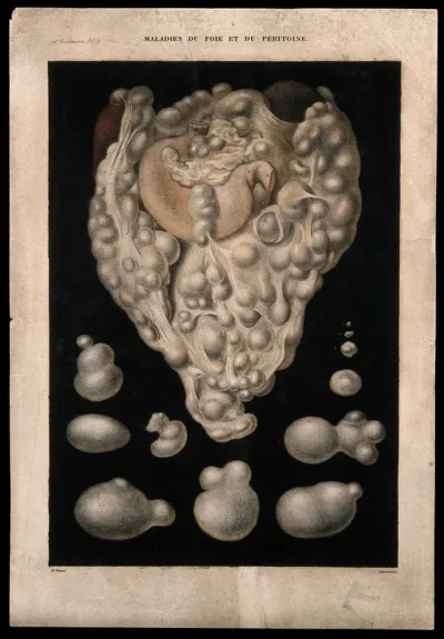 Several sections of diseased liver