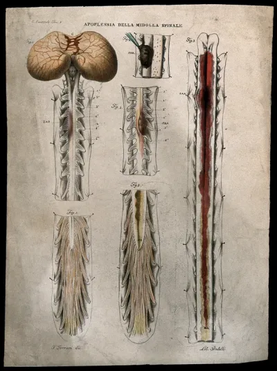 Several sections of diseased spinal cord showing blood clots and haemorrhage, numbered for key