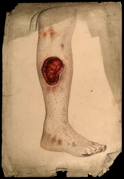 Severely diseased area of tissue on the calf of a woman's leg