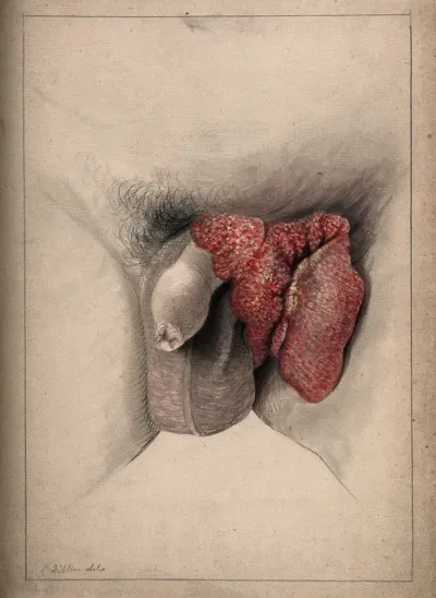 Severely diseased area of tissue on the genitals and groin of a man