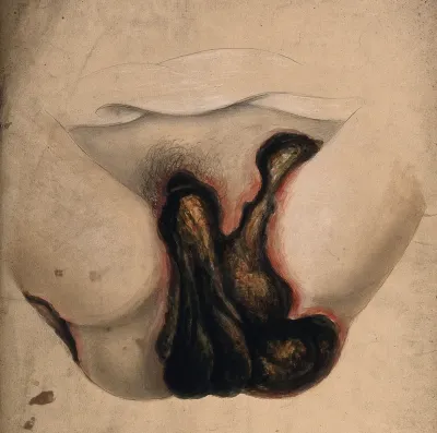 Severely diseased genitals and thighs of a woman