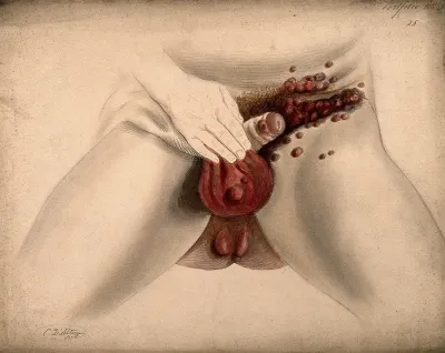 Severely diseased genitals, groin and anal region of a man