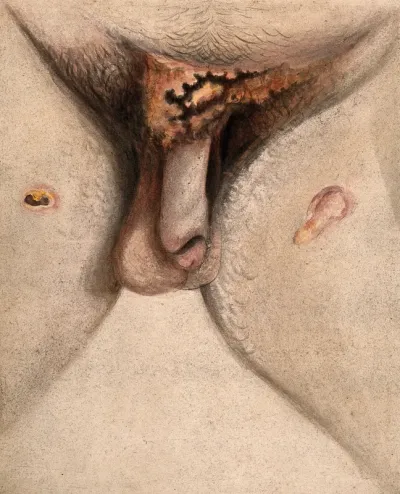 Severely diseased genitals, groin and thighs of a man, showing symptoms of perforating phagedena