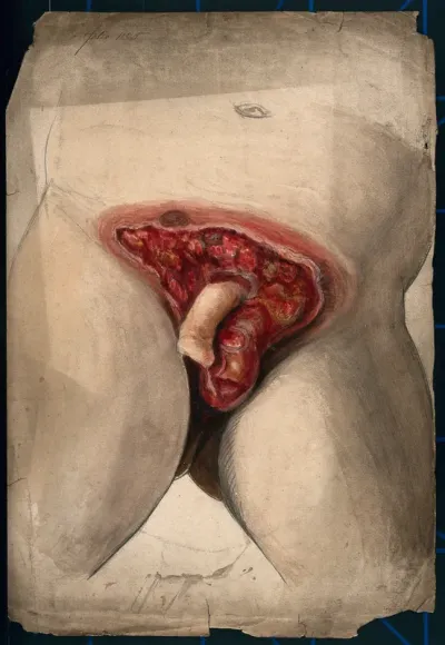 Severely diseased genitals of a man