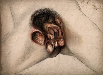 Severely diseased genitals of a woman, showing symptoms of sloughing phagedena