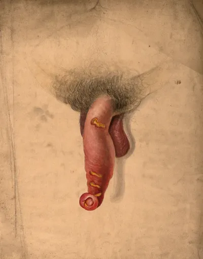Severely diseased, inflamed and deformed genitals of a man