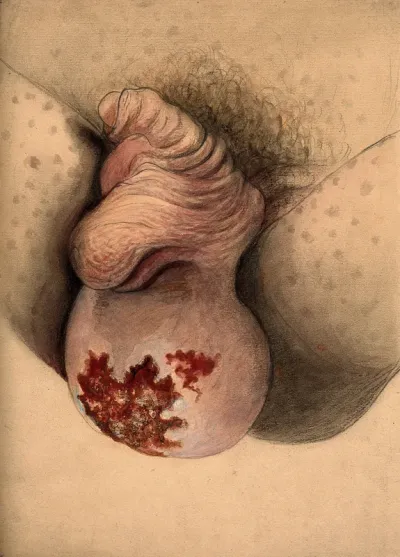 Severely diseased scrotum with a large growth or tumour