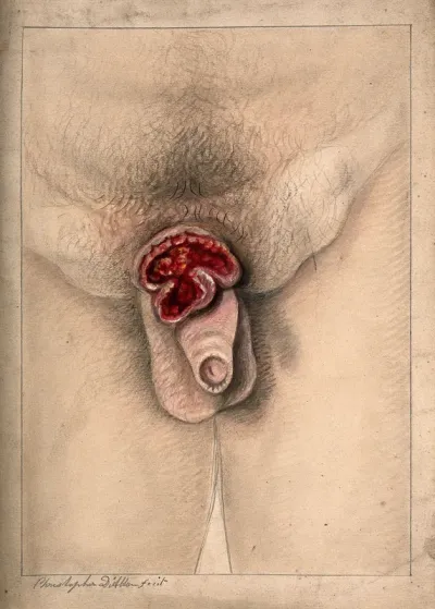 Severely diseased scrotum