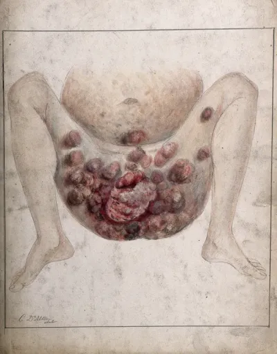 Severely diseased tissue and abcesses on the buttocks, genital area and thighs of a two year old boy