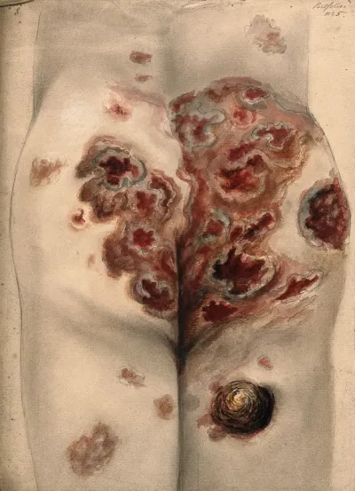 Severely diseased tissue on the buttocks and thighs of a man