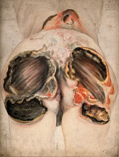 Severely diseased tissue on the buttocks of a dead woman, showing symptoms of creeping or serpiginous phagedena