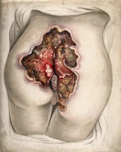 Severely diseased tissue on the buttocks of a woman, showing symptoms of creeping or serpiginous phagedena