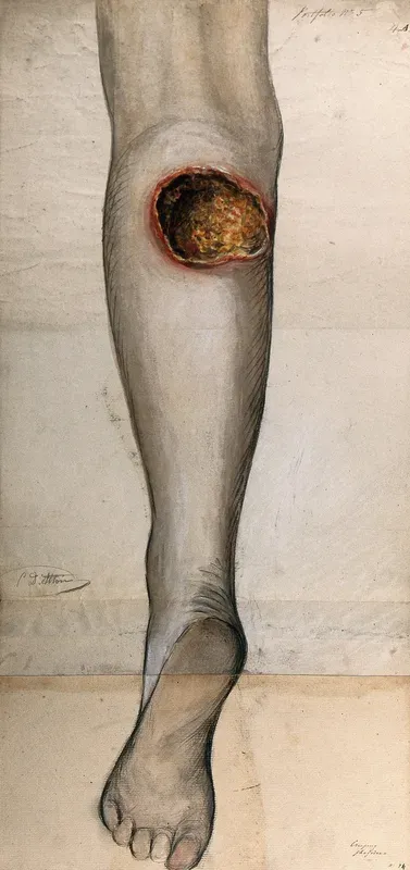 Severely diseased tissue on the calf of a woman's leg, showing symptoms of creeping phagedena