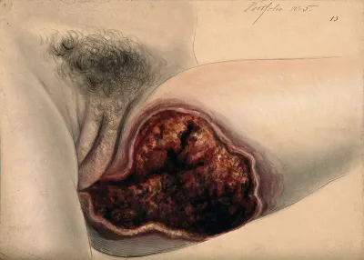 Severely diseased tissue on the inner thigh of a woman